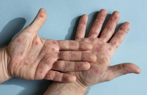Monkeypox can leave a painful rash, lasting for about two to four weeks.